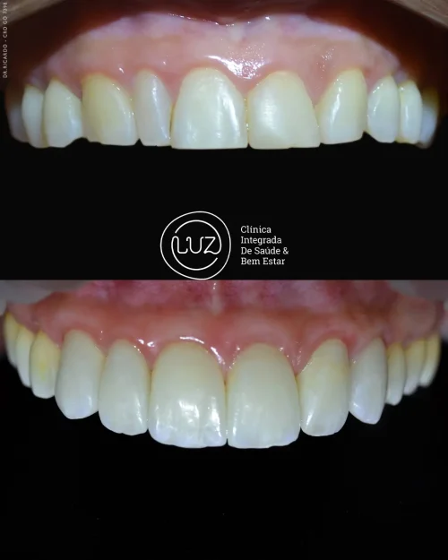 MODELO DE ANTES E DEPOIS 06